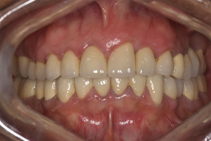 Full Mouth Rehabilitation