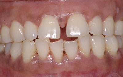 Gaps Between front teeth
