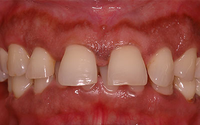 Gaps Between front teeth