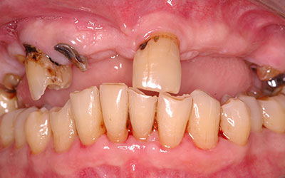 Missing Teeth