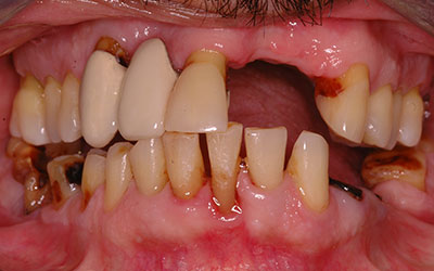 Missing Teeth
