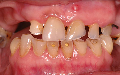 Missing Teeth