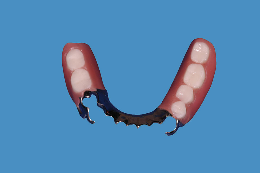 Removable Partial Denture