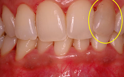 Single Dark Non Vital Tooth