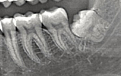 Stuck Wisdom Tooth