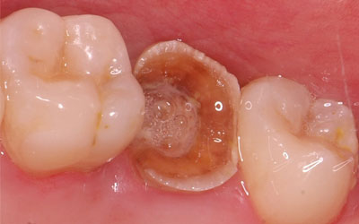 Black Spot on Tooth