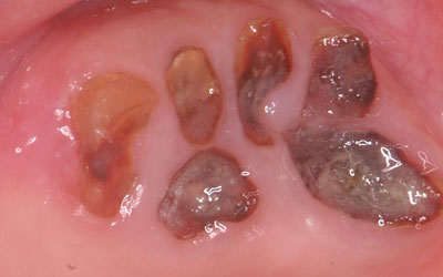 Black Spot on Tooth