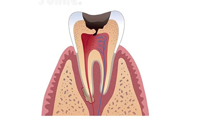 Tooth Extraction